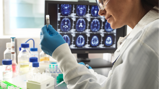 Gli scienziati identificano la causa della progressione dell’Alzheimer attraverso la ricerca human-based